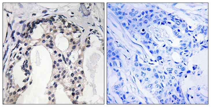 NF2 / Merlin Antibody - Immunohistochemistry analysis of paraffin-embedded human breast carcinoma, using Merlin (Phospho-Ser10) Antibody. The picture on the right is blocked with the phospho peptide.