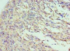 NF90 / ILF3 Antibody - Immunohistochemistry of paraffin-embedded human cervical cancer using antibody at 1:100 dilution.