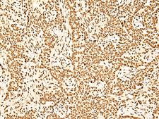 NF90 / ILF3 Antibody - Immunohistochemistry of paraffin-embedded Human ovarian cancer tissue  using ILF3 Polyclonal Antibody at dilution of 1:60(×200)