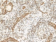 NF90 / ILF3 Antibody - Immunohistochemistry of paraffin-embedded Human esophagus cancer tissue  using ILF3 Polyclonal Antibody at dilution of 1:40(×200)