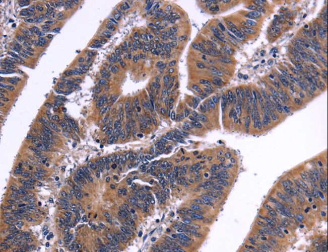 NFAT4 / NFATC3 Antibody - Immunohistochemistry of paraffin-embedded Human liver cancer using NFATC3 Polyclonal Antibody at dilution of 1:50.