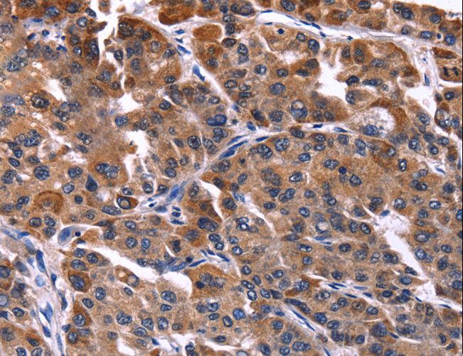 NFAT4 / NFATC3 Antibody - Immunohistochemistry of paraffin-embedded Human liver cancer using NFATC3 Polyclonal Antibody at dilution of 1:50.