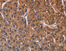 NFAT4 / NFATC3 Antibody - Immunohistochemistry of paraffin-embedded Human colon cancer using NFATC3 Polyclonal Antibody at dilution of 1:60.