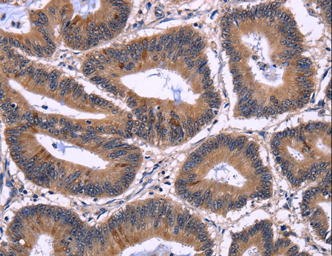 NFAT4 / NFATC3 Antibody - Immunohistochemistry of paraffin-embedded Human colon cancer using NFATC3 Polyclonal Antibody at dilution of 1:60.