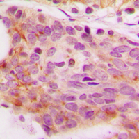 NFAT4 / NFATC3 Antibody - Immunohistochemical analysis of NFAT4 (pS165) staining in human breast cancer formalin fixed paraffin embedded tissue section. The section was pre-treated using heat mediated antigen retrieval with sodium citrate buffer (pH 6.0). The section was then incubated with the antibody at room temperature and detected using an HRP conjugated compact polymer system. DAB was used as the chromogen. The section was then counterstained with hematoxylin and mounted with DPX.
