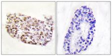 NFAT5 Antibody - Peptide - + Immunohistochemistry analysis of paraffin-embedded human breast carcinoma tissue using NFAT5 antibody.