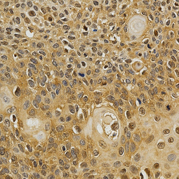 NFATC1 / NFAT2 Antibody - Immunohistochemistry of paraffin-embedded human esophageal cancer using NFATC1 antibody at dilution of 1:200 (x400 lens).