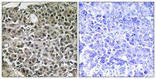 NFATC4 / NFAT3 Antibody - Immunohistochemistry analysis of paraffin-embedded human breast carcinoma tissue, using NFAT3 Antibody. The picture on the right is blocked with the synthesized peptide.