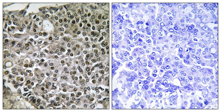 NFATC4 / NFAT3 Antibody - Peptide - + Immunohistochemistry analysis of paraffin-embedded human breast carcinoma tissue using NFAT3 (Ab-676) antibody.