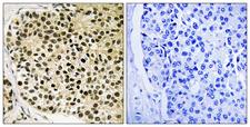 NFATC4 / NFAT3 Antibody - Immunohistochemistry analysis of paraffin-embedded human breast carcinoma, using NFAT3 (Phospho-Ser168+Ser170) Antibody. The picture on the right is blocked with the phospho peptide.