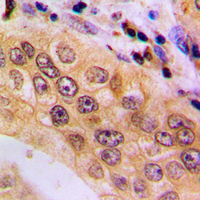 NFATC4 / NFAT3 Antibody - Immunohistochemical analysis of NFAT3 (pS676) staining in human lung cancer formalin fixed paraffin embedded tissue section. The section was pre-treated using heat mediated antigen retrieval with sodium citrate buffer (pH 6.0). The section was then incubated with the antibody at room temperature and detected using an HRP conjugated compact polymer system. DAB was used as the chromogen. The section was then counterstained with hematoxylin and mounted with DPX.