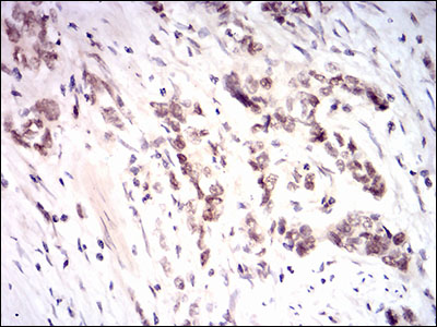 NFE2L2 / NRF2 Antibody - IHC of paraffin-embedded stomach cancer tissues using NFE2L2 mouse monoclonal antibody with DAB staining.