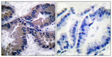 NFE2L2 / NRF2 Antibody - Immunohistochemistry analysis of paraffin-embedded human lung carcinoma tissue, using Nrf2 Antibody. The picture on the right is blocked with the synthesized peptide.