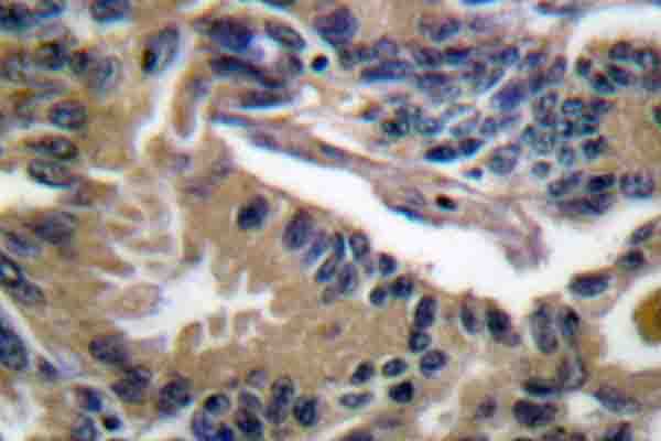 NFE2L2 / NRF2 Antibody - IHC of Nrf2/NFE2L2 (L593) pAb in paraffin-embedded human lung carcinoma tissue.