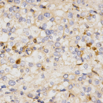 NFE2L2 / NRF2 Antibody - Immunohistochemistry of paraffin-embedded human kidney cancer using NFE2L2 antibody at dilution of 1:200 (x400 lens).