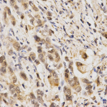 NFE2L2 / NRF2 Antibody - Immunohistochemistry of paraffin-embedded human stomach cancer using NFE2L2 antibody at dilution of 1:200 (x400 lens).
