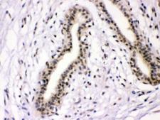 NFIA / Nuclear Factor 1 Antibody - IHC testing of FFPE human breast cancer tissue with NFIA antibody at 1ug/ml. HIER: steam section in pH6 citrate buffer for 20 min.