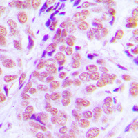 NFIA / Nuclear Factor 1 Antibody - Immunohistochemical analysis of NFIA staining in human breast cancer formalin fixed paraffin embedded tissue section. The section was pre-treated using heat mediated antigen retrieval with sodium citrate buffer (pH 6.0). The section was then incubated with the antibody at room temperature and detected using an HRP conjugated compact polymer system. DAB was used as the chromogen. The section was then counterstained with hematoxylin and mounted with DPX.