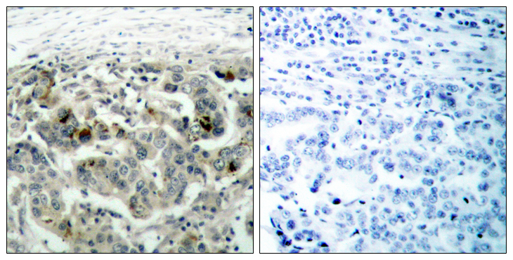 NFKB1 / NF-Kappa-B Antibody - Immunohistochemistry analysis of paraffin-embedded human breast carcinoma tissue, using NF-kappaB p105/p50 Antibody. The picture on the right is blocked with the synthesized peptide.