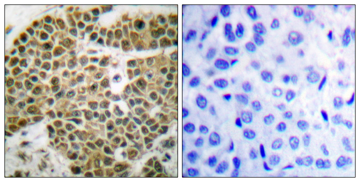 NFKB1 / NF-Kappa-B Antibody - Immunohistochemistry analysis of paraffin-embedded human breast carcinoma tissue, using NF-kappaB p105/p50 Antibody. The picture on the right is blocked with the synthesized peptide.