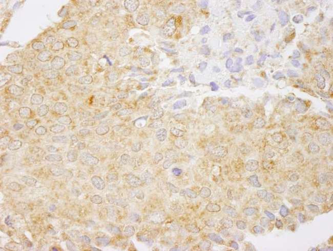 NFKB1 / NF-Kappa-B Antibody - Detection of Human NF-kappaB1 Immunohistochemistry. Sample: FFPE section of human breast carcinoma. Antibody: Affinity purified rabbit anti-NF-kappaB1 used at a dilution of 1:250.