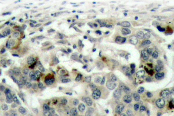 NFKB1 / NF-Kappa-B Antibody - IHC of NFB-p105/p50 (A901) pAb in paraffin-embedded human breast carcinoma tissue.