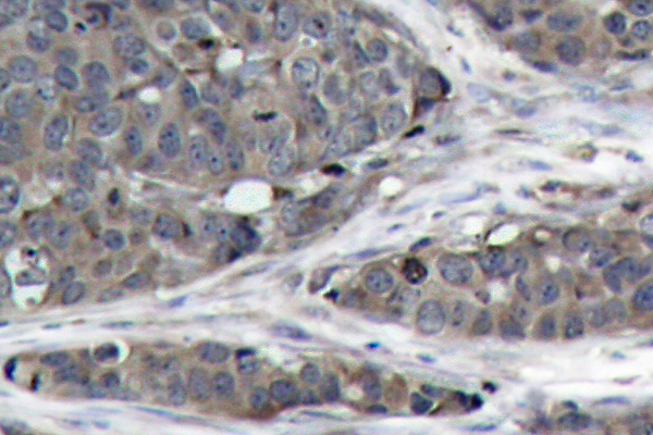 NFKB1 / NF-Kappa-B Antibody - IHC of NFB-p105/p50 (D926)pAb in paraffin-embedded human breast carcinoma tissue.