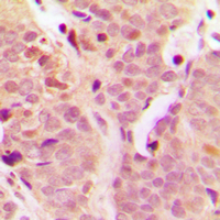 NFKB1 / NF-Kappa-B Antibody - Immunohistochemical analysis of NF-kappaB p105 staining in human breast cancer formalin fixed paraffin embedded tissue section. The section was pre-treated using heat mediated antigen retrieval with sodium citrate buffer (pH 6.0). The section was then incubated with the antibody at room temperature and detected using an HRP conjugated compact polymer system. DAB was used as the chromogen. The section was then counterstained with hematoxylin and mounted with DPX.