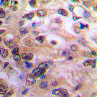 NFKB1 / NF-Kappa-B Antibody - Immunohistochemical analysis of NF-kappaB p105 staining in human prostate cancer formalin fixed paraffin embedded tissue section. The section was pre-treated using heat mediated antigen retrieval with sodium citrate buffer (pH 6.0). The section was then incubated with the antibody at room temperature and detected using an HRP conjugated compact polymer system. DAB was used as the chromogen. The section was then counterstained with hematoxylin and mounted with DPX.