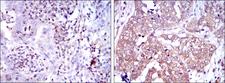 NFKB1 / NF-Kappa-B Antibody - IHC of paraffin-embedded human intima cancer tissues (left) and human bladder cancer tissues (right) using NFKB1 mouse monoclonal antibody with DAB staining.