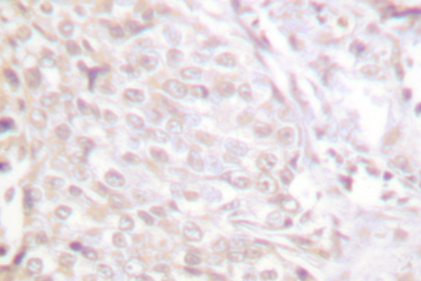 NFKB1 / NF-Kappa-B Antibody - IHC of NFB-p105/p50 (Q332) pAb in paraffin-embedded human breast carcinoma tissue.