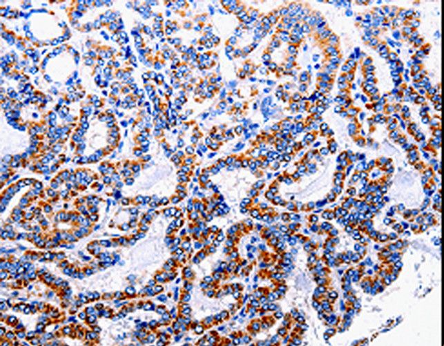 NFKB1 / NF-Kappa-B Antibody - Immunohistochemistry of paraffin-embedded Human thyroid cancer using NFKB1p105 Polyclonal Antibody at dilution of 1:40.