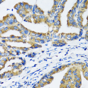 NFKB1 / NF-Kappa-B Antibody - Immunohistochemistry of paraffin-embedded human gastric cancer using NFKB1 antibody at dilution of 1:100 (40x lens).