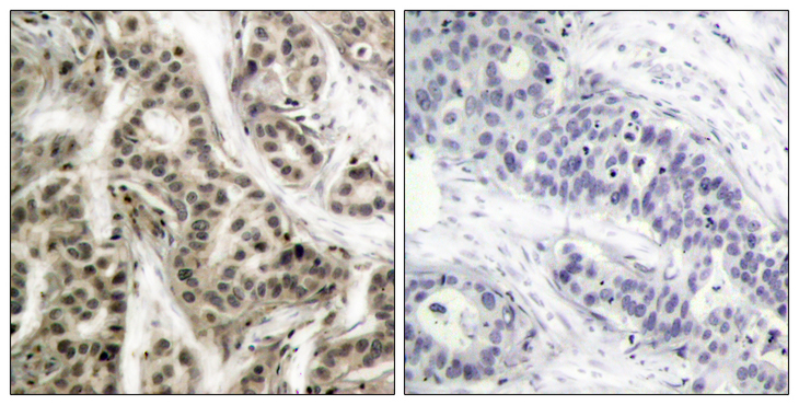NFKB1 / NF-Kappa-B Antibody - Immunohistochemistry analysis of paraffin-embedded human breast carcinoma, using NF-kappaB p105/p50 (Phospho-Ser337) Antibody. The picture on the right is blocked with the phospho peptide.