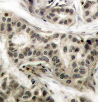 NFKB1 / NF-Kappa-B Antibody - Immunohistochemical analysis of paraffin-embedded human breast carcinoma tissue.