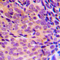 NFKB1 / NF-Kappa-B Antibody - Immunohistochemical analysis of NF-kappaB p105/p50 (pS337) staining in human breast cancer formalin fixed paraffin embedded tissue section. The section was pre-treated using heat mediated antigen retrieval with sodium citrate buffer (pH 6.0). The section was then incubated with the antibody at room temperature and detected using an HRP conjugated compact polymer system. DAB was used as the chromogen. The section was then counterstained with hematoxylin and mounted with DPX.
