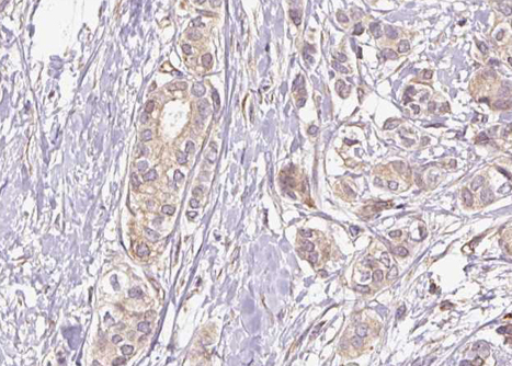 NFKB1 / NF-Kappa-B Antibody - 1:100 staining human breast carcinoma tissue by IHC-P. The tissue was formaldehyde fixed and a heat mediated antigen retrieval step in citrate buffer was performed. The tissue was then blocked and incubated with the antibody for 1.5 hours at 22°C. An HRP conjugated goat anti-rabbit antibody was used as the secondary.