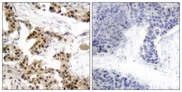 NFKB1 / NF-Kappa-B Antibody - Immunohistochemistry analysis of paraffin-embedded human breast carcinoma, using NF-kappaB p105/p50 (Phospho-Ser893) Antibody. The picture on the right is blocked with the phospho peptide.