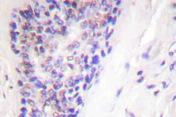 NFKB1 / NF-Kappa-B Antibody - Immunohistochemistry (IHC) analysis of p-NF kappa B-p105 (S927) pAb in paraffin-embedded human breast cancer tissue.
