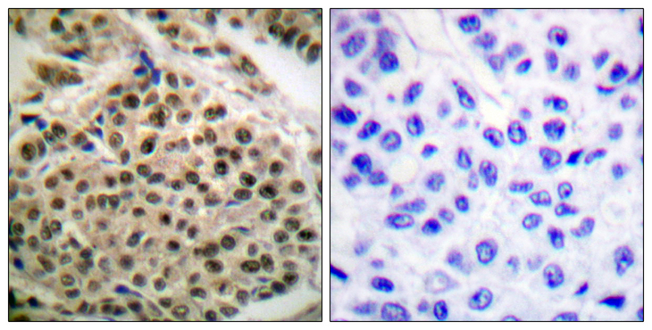NFKB1 / NF-Kappa-B Antibody - Immunohistochemistry analysis of paraffin-embedded human breast carcinoma, using NF-kappaB p105/p50 (Phospho-Ser927) Antibody. The picture on the right is blocked with the phospho peptide.
