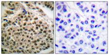 NFKB1 / NF-Kappa-B Antibody - P-peptide - + Immunohistochemical analysis of paraffin-embedded human breast carcinoma tissue using NF-?B p105/p50 (phospho-Ser927) antibody.