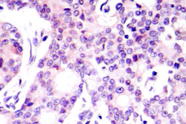 NFKB1 / NF-Kappa-B Antibody - IHC of NFB-p105/p50 (V887) pAb in paraffin-embedded human breast carcinoma tissue.