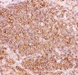 NFKB2 Antibody - NFkB p100 antibody IHC-paraffin: Human Lung Cancer Tissue.