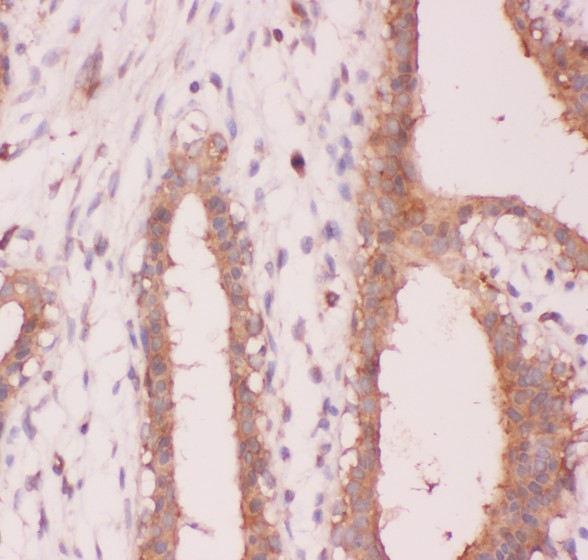 NFKB2 Antibody - NFkB p100 antibody IHC-paraffin: Human Mammary Cancer Tissue.