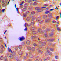 NFKB2 Antibody - Immunohistochemical analysis of NF-kappaB p100 staining in human breast cancer formalin fixed paraffin embedded tissue section. The section was pre-treated using heat mediated antigen retrieval with sodium citrate buffer (pH 6.0). The section was then incubated with the antibody at room temperature and detected using an HRP conjugated compact polymer system. DAB was used as the chromogen. The section was then counterstained with hematoxylin and mounted with DPX.