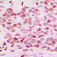 NFKB2 Antibody - Immunohistochemical analysis of NF-kappaB p100 (pS865) staining in human breast cancer formalin fixed paraffin embedded tissue section. The section was pre-treated using heat mediated antigen retrieval with sodium citrate buffer (pH 6.0). The section was then incubated with the antibody at room temperature and detected using an HRP conjugated compact polymer system. DAB was used as the chromogen. The section was then counterstained with hematoxylin and mounted with DPX.