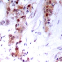 NFKB2 Antibody - Immunohistochemical analysis of NF-kappaB p100 staining in human breast cancer formalin fixed paraffin embedded tissue section. The section was pre-treated using heat mediated antigen retrieval with sodium citrate buffer (pH 6.0). The section was then incubated with the antibody at room temperature and detected using an HRP polymer system. DAB was used as the chromogen. The section was then counterstained with hematoxylin and mounted with DPX.