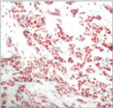 NFKB2 Antibody - Detection of NF?B-p100 (phospho-Ser866) in paraffin-embedded human breast carcinoma tissue.