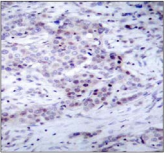 NFKB2 Antibody - Detection of NF?B-p100 (phospho-Ser870) in paraffin-embedded human breast carcinoma tissue.