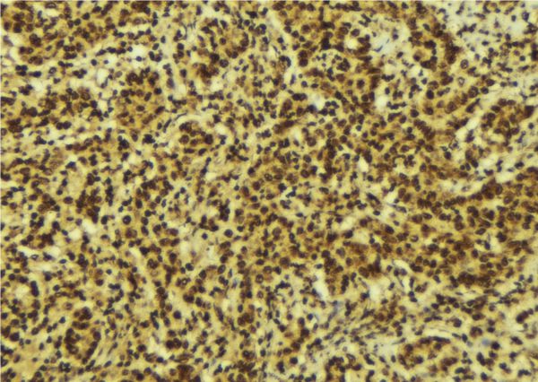 NFKB2 Antibody - 1:100 staining human breast carcinoma tissue by IHC-P. The sample was formaldehyde fixed and a heat mediated antigen retrieval step in citrate buffer was performed. The sample was then blocked and incubated with the antibody for 1.5 hours at 22°C. An HRP conjugated goat anti-rabbit antibody was used as the secondary.